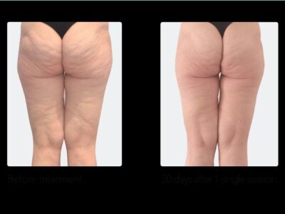 Buttocks and legs Cellulite