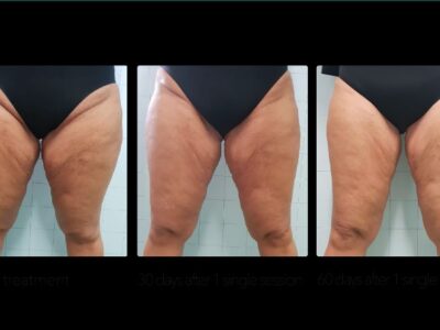Legs Cellulite 1 ater 2 month